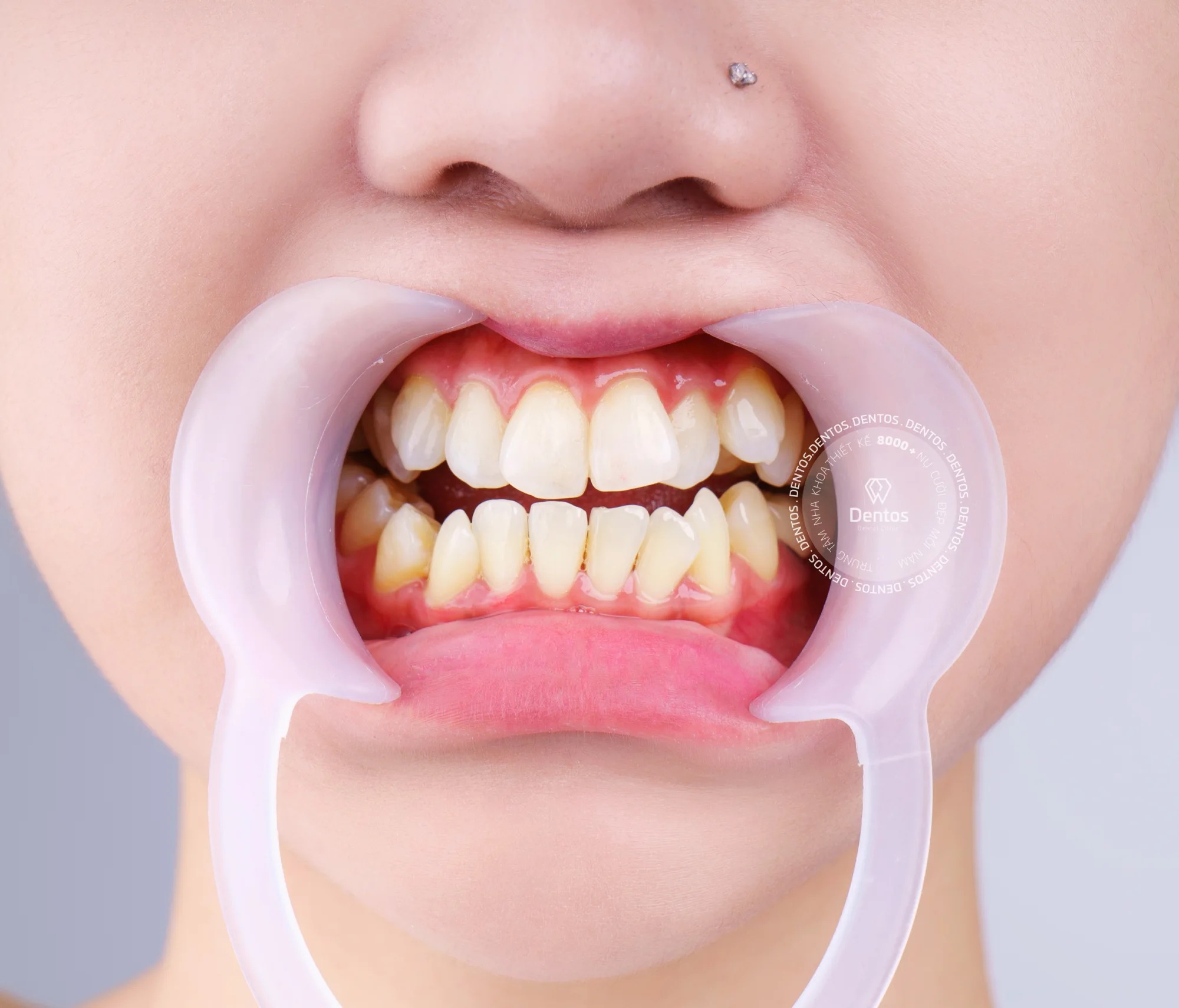 Tình trạng răng khấp khểnh có thể do nhiều nguyên nhân gây ra